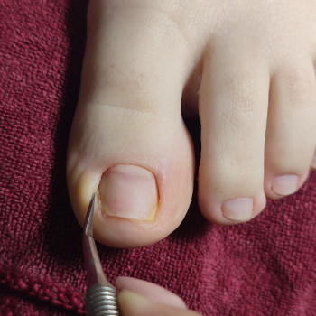 Тампонада каполіном
50 грн за 1 шт.