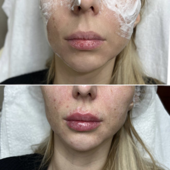 Увеличение губ, скул, подбородка, углов нижней челюсти, заполнение носогубных складок и морщин
                    Косметолог-инъекционист Анна Ужгород