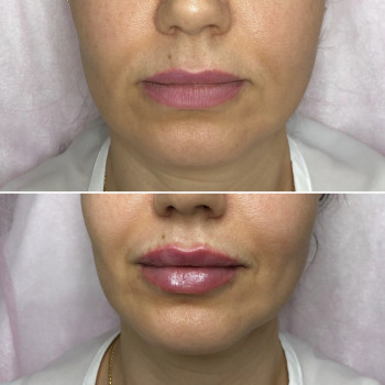 Увеличение губ, скул, подбородка, углов нижней челюсти, заполнение носогубных складок и морщин
                    Косметолог-инъекционист Анна Ужгород