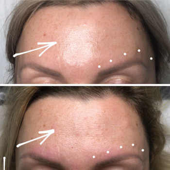 Увеличение губ, скул, подбородка, углов нижней челюсти, заполнение носогубных складок и морщин
                    Косметолог-инъекционист Анна Ужгород