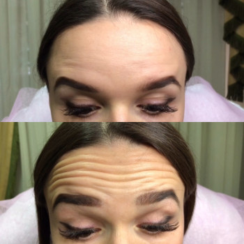 Увеличение губ, скул, подбородка, углов нижней челюсти, заполнение носогубных складок и морщин
                    Косметолог-инъекционист Анна Ужгород