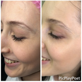 Увеличение губ, скул, подбородка, углов нижней челюсти, заполнение носогубных складок и морщин
                    Косметолог-инъекционист Анна Ужгород