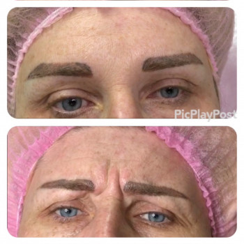 Увеличение губ, скул, подбородка, углов нижней челюсти, заполнение носогубных складок и морщин
                    Косметолог-инъекционист Анна Ужгород