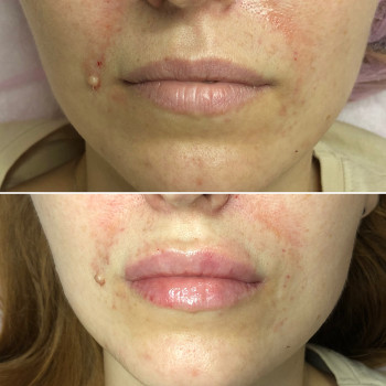 Увеличение губ, скул, подбородка, углов нижней челюсти, заполнение носогубных складок и морщин
                    Косметолог-инъекционист Анна Ужгород