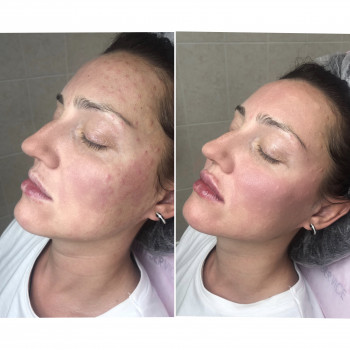 Увеличение губ, скул, подбородка, углов нижней челюсти, заполнение носогубных складок и морщин
                    Косметолог-инъекционист Анна Ужгород