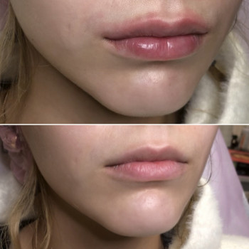 Увеличение губ, скул, подбородка, углов нижней челюсти, заполнение носогубных складок и морщин
                    Косметолог-инъекционист Анна Ужгород