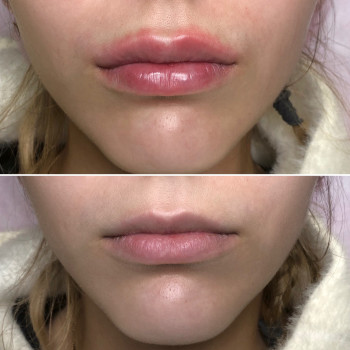 Увеличение губ, скул, подбородка, углов нижней челюсти, заполнение носогубных складок и морщин
                    Косметолог-инъекционист Анна Ужгород