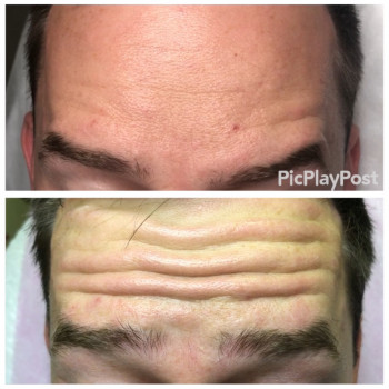 Увеличение губ, скул, подбородка, углов нижней челюсти, заполнение носогубных складок и морщин
                    Косметолог-инъекционист Анна Ужгород