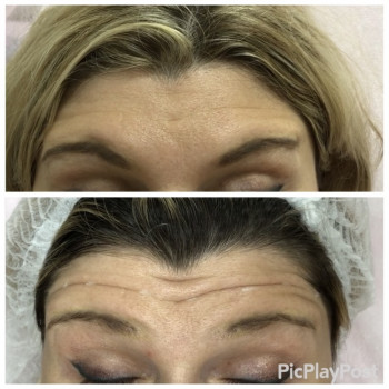 Увеличение губ, скул, подбородка, углов нижней челюсти, заполнение носогубных складок и морщин
                    Косметолог-инъекционист Анна Ужгород