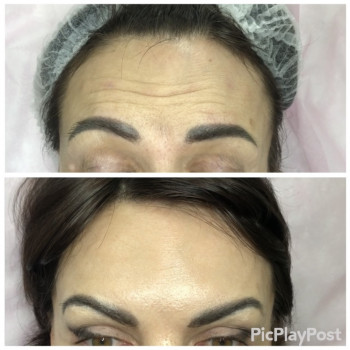 Увеличение губ, скул, подбородка, углов нижней челюсти, заполнение носогубных складок и морщин
                    Косметолог-инъекционист Анна Ужгород