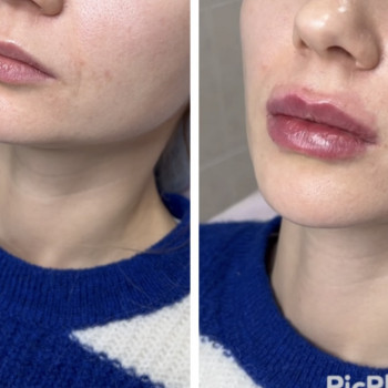 Увеличение губ, скул, подбородка, углов нижней челюсти, заполнение носогубных складок и морщин
                    Косметолог-инъекционист Анна Ужгород