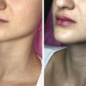 Увеличение губ, скул, подбородка, углов нижней челюсти, заполнение носогубных складок и морщин
                    Косметолог-инъекционист Анна Ужгород