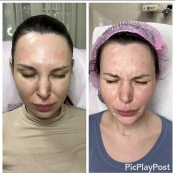 Увеличение губ, скул, подбородка, углов нижней челюсти, заполнение носогубных складок и морщин
                    Косметолог-инъекционист Анна Ужгород