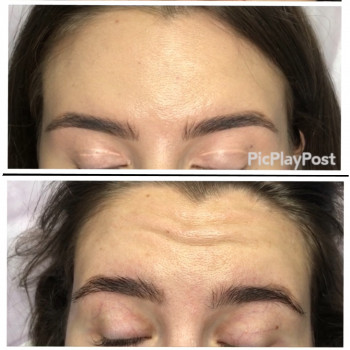 Увеличение губ, скул, подбородка, углов нижней челюсти, заполнение носогубных складок и морщин
                    Косметолог-инъекционист Анна Ужгород