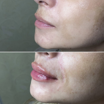 Увеличение губ, скул, подбородка, углов нижней челюсти, заполнение носогубных складок и морщин
                    Косметолог-инъекционист Анна Ужгород