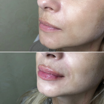 Увеличение губ, скул, подбородка, углов нижней челюсти, заполнение носогубных складок и морщин
                    Косметолог-инъекционист Анна Ужгород