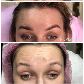 Устранение морщин Ботоксом и Нейроноксом
                    Косметолог-ін'єкціоніст Анна Ужгород