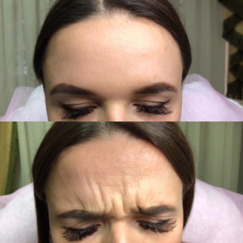 Устранение морщин Ботоксом и Нейроноксом
                    Косметолог-ін'єкціоніст Анна Ужгород