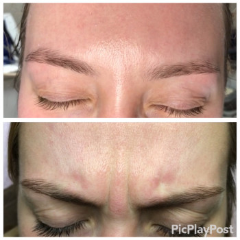 Устранение морщин Ботоксом и Нейроноксом
                    Косметолог-ін'єкціоніст Анна Ужгород