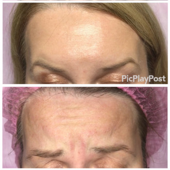 Устранение морщин Ботоксом и Нейроноксом
                    Косметолог-ін'єкціоніст Анна Ужгород