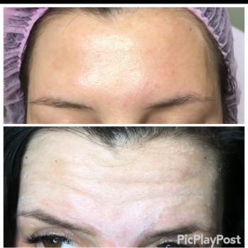 Устранение морщин Ботоксом и Нейроноксом
                    Косметолог-ін'єкціоніст Анна Ужгород