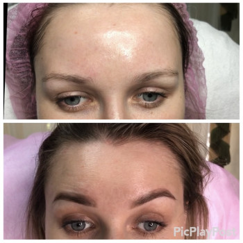 Устранение морщин Ботоксом и Нейроноксом
                    Косметолог-ін'єкціоніст Анна Ужгород