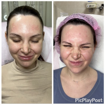 Устранение морщин Ботоксом и Нейроноксом
                    Косметолог-ін'єкціоніст Анна Ужгород