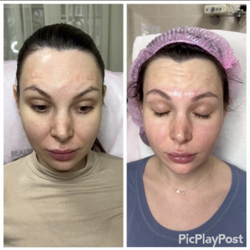 Устранение морщин Ботоксом и Нейроноксом
                    Косметолог-ін'єкціоніст Анна Ужгород