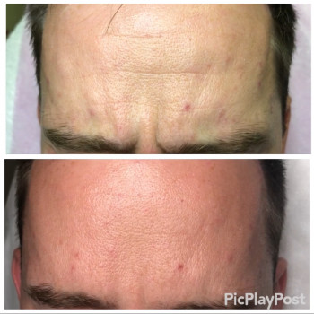 Устранение морщин Ботоксом и Нейроноксом
                    Косметолог-ін'єкціоніст Анна Ужгород