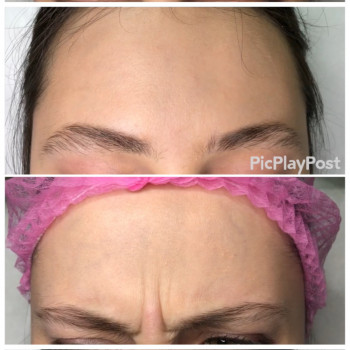 Устранение морщин Ботоксом и Нейроноксом
                    Косметолог-ін'єкціоніст Анна Ужгород