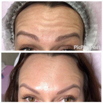 Устранение морщин Ботоксом и Нейроноксом
                    Косметолог-ін'єкціоніст Анна Ужгород