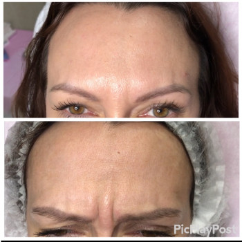 Устранение морщин Ботоксом и Нейроноксом
                    Косметолог-ін'єкціоніст Анна Ужгород