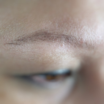 Зажившие перед коррекцией