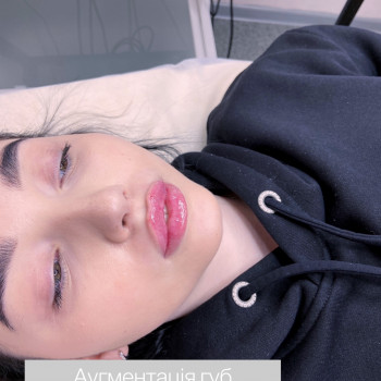 Збільшення губ
                    Косметолог-инъекционист Марина Николаев