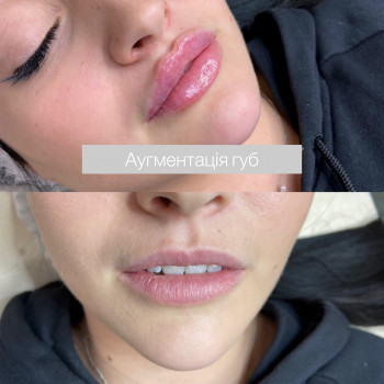 Збільшення губ
                    Косметолог-инъекционист Марина Николаев