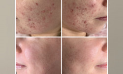 Лікування акне Дерматолог косметолог Марта Львів