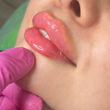 Увеличение и бьютификация губ
                    Косметолог Ирина Кривой Рог