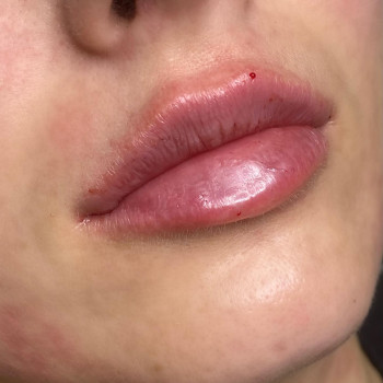 Збільшення губ