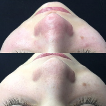 Чистка носа