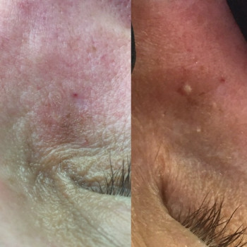 Видалення вапняків