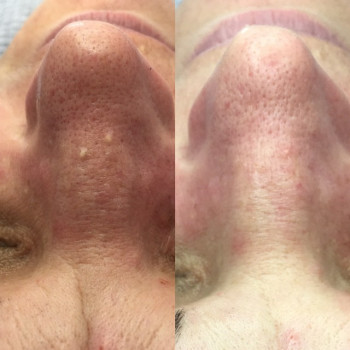 Чистка +видалення