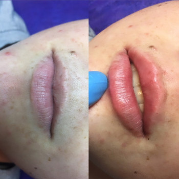 Формування губ