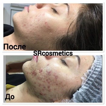 После 6-ти процедур + домашний уход