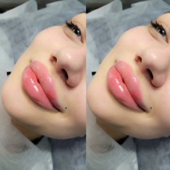 Збільшення губ
                    Салон краси MM Studio Тернопіль