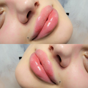 Збільшення губ
                    Салон краси MM Studio Тернопіль