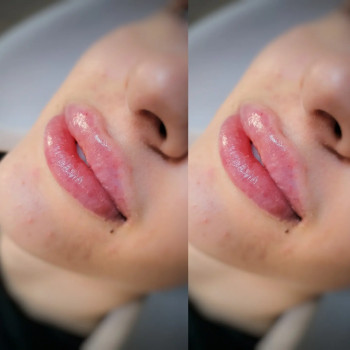 Збільшення губ
                    Салон краси MM Studio Тернопіль