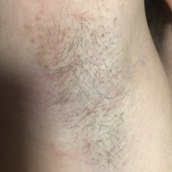 Электроэпиляция
                    Мастер депиляции Ольга Одесса