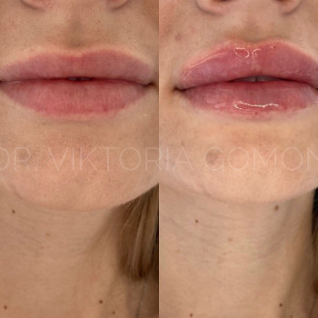 Контурна пластика губ
                    Косметологічний центр Dr. Gomon Cosmetology Черкаси