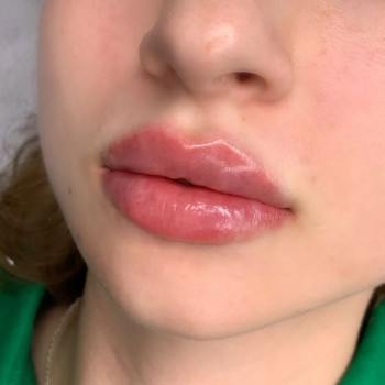 Корекція форми губ