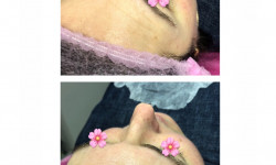 Пілінг Долина Косметолог Тетяна Долина